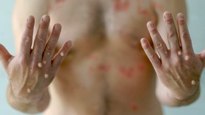 Kongo Demokratik Cumhuriyeti'nde hızla yayılan M çiçeği (Mpox) salgınında ölü