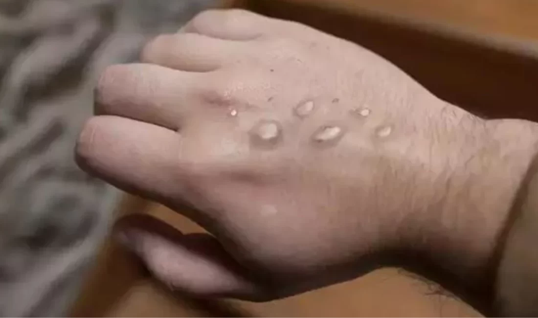 Pakistan Sağlık Bakanlığı, Körfez ülkelerinden dönen üç kişide mpox virüsü