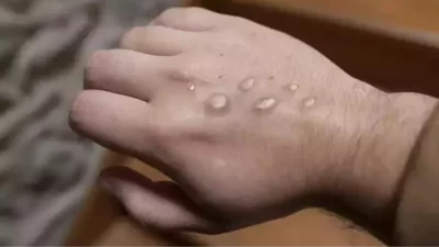 Pakistan Sağlık Bakanlığı, Körfez ülkelerinden dönen üç kişide mpox virüsü