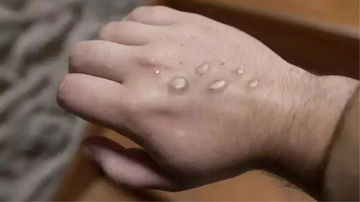 Pakistan Sağlık Bakanlığı, Körfez ülkelerinden dönen üç kişide mpox virüsü