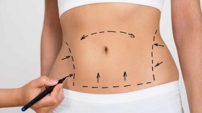 Karın germe ameliyatı hakkında açıklama yapan uzmanlar, operasyon hakkında önemli