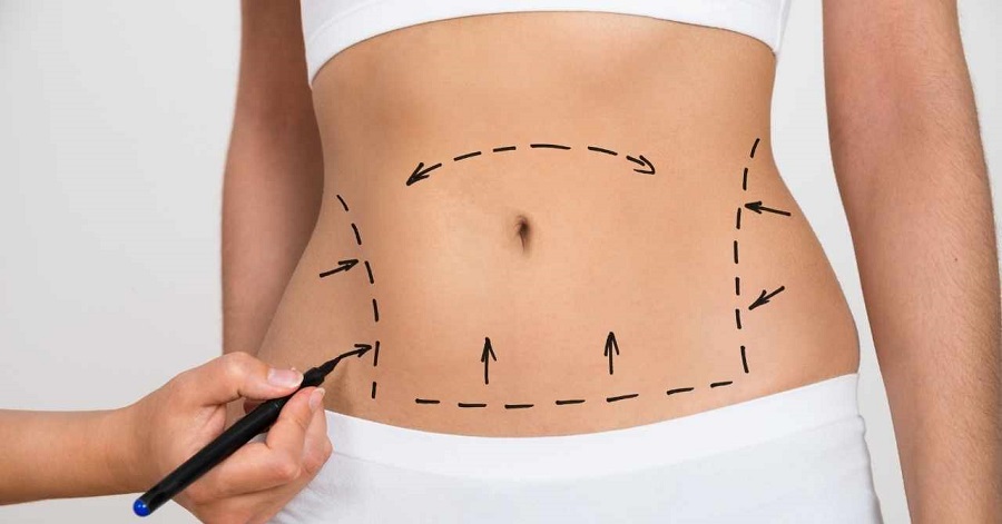 Karın germe ameliyatı hakkında açıklama yapan uzmanlar, operasyon hakkında önemli