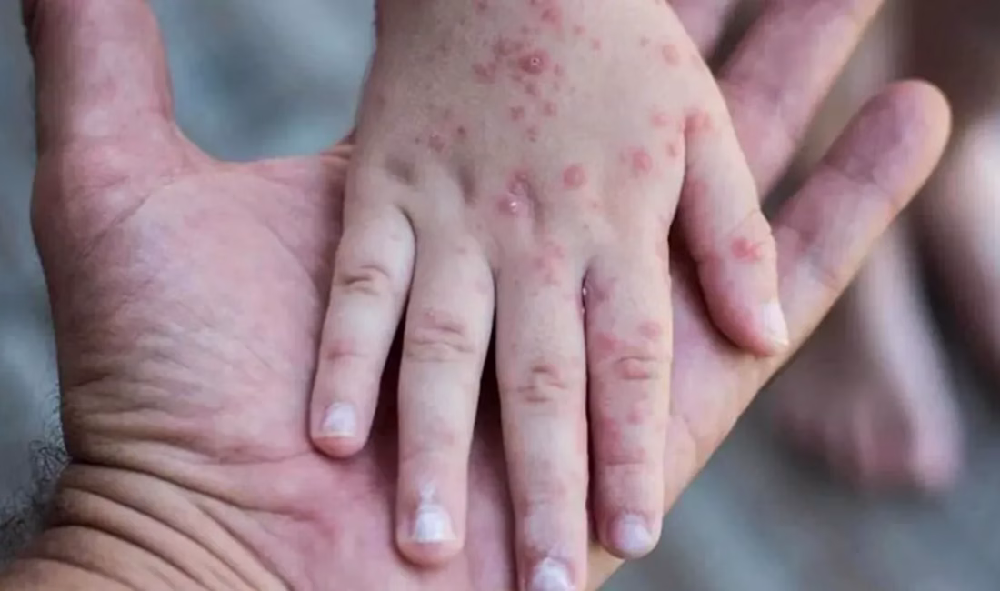 Endonezya’da kızamık salgını: 17 kişi hayatını kaybetti Jakarta Globe’un haberine göre, ülkedeki kızamık vakaları hızla artarken, Doğu